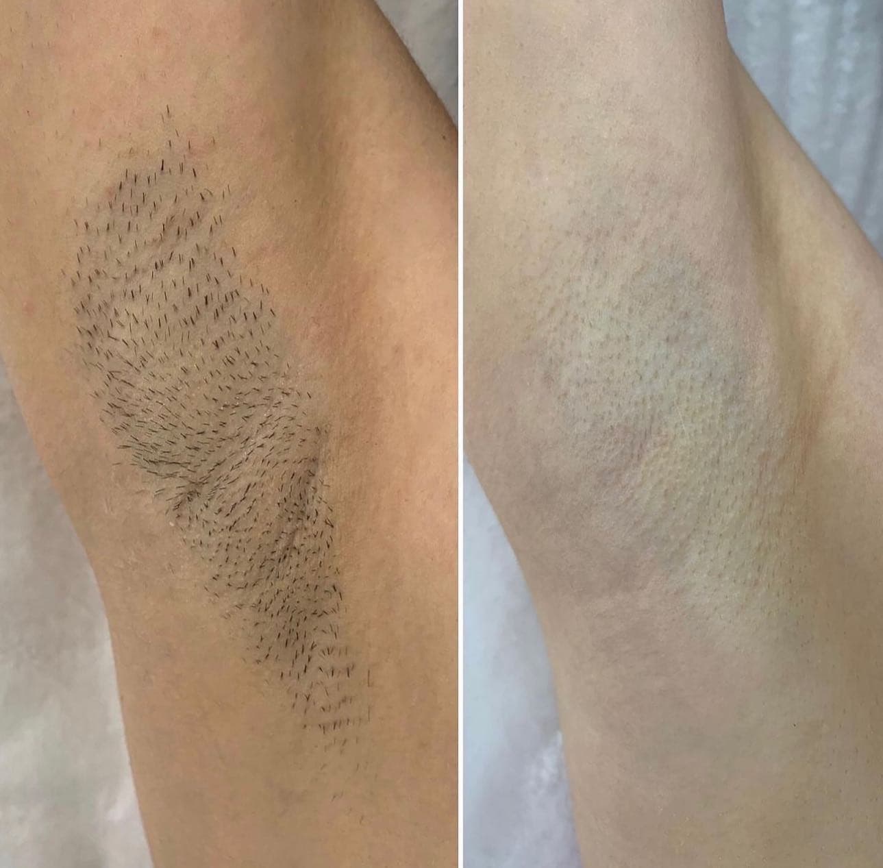 Before and after underarm laser hair removal result